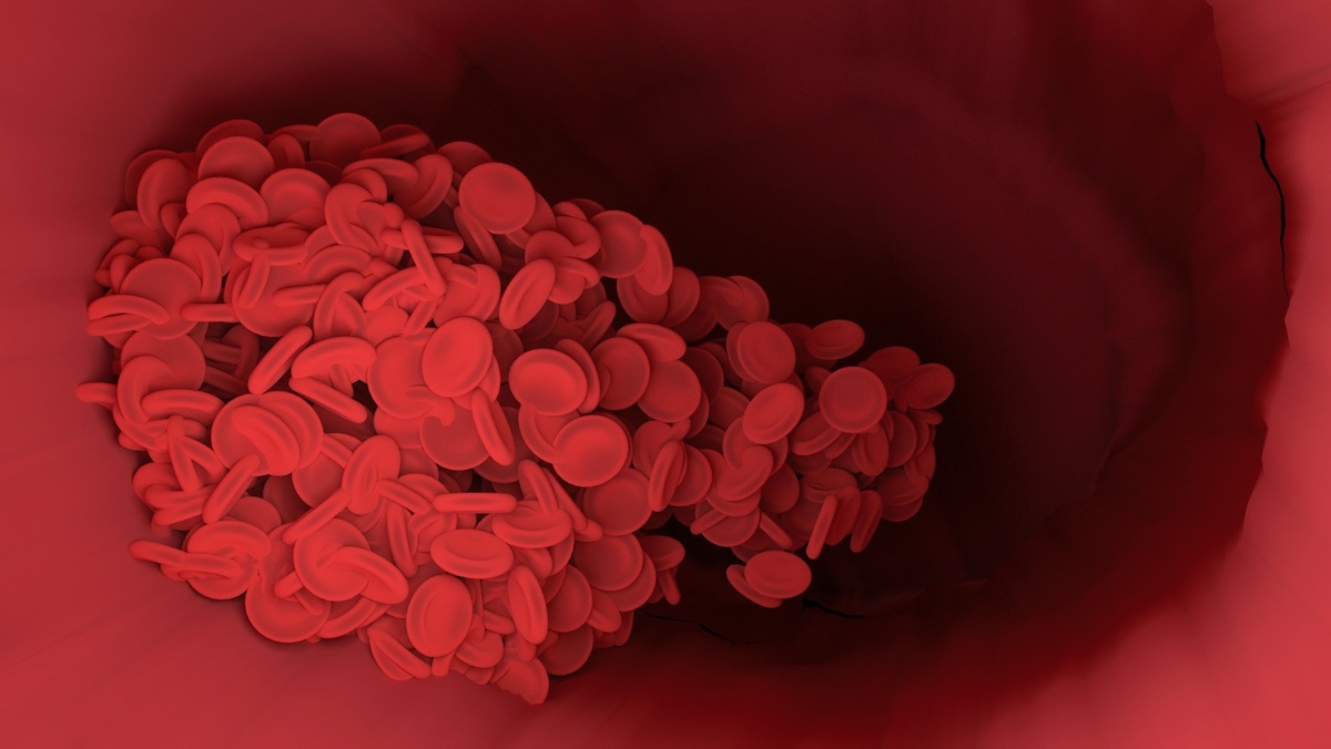 Всемирный день тромбоза: когда кровь против нас